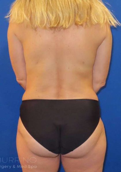 Breast Augmentation Before & After Patient #2101