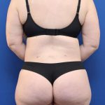 Lower Body Lift Before & After Patient #598