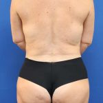 Liposuction Before & After Patient #626