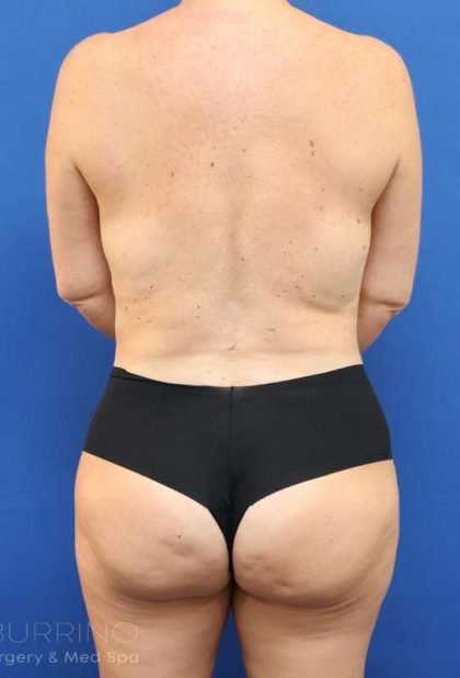 Liposuction Before & After Patient #626