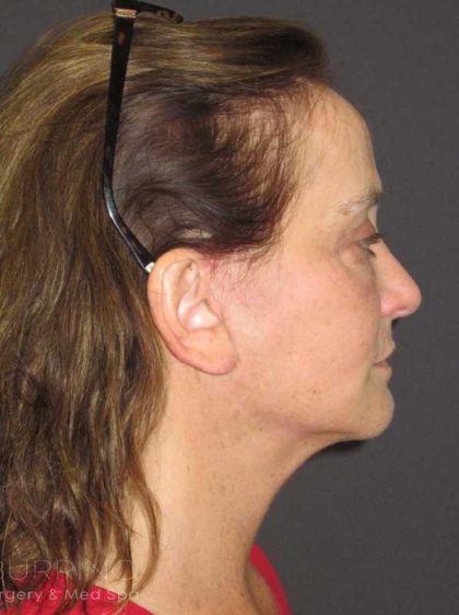 Chemical Peel Before & After Patient #436
