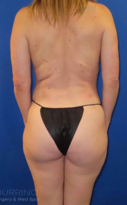 Liposuction Before & After Patient #681