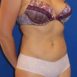 Liposuction Before & After Patient #749