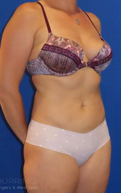 Liposuction Before & After Patient #749