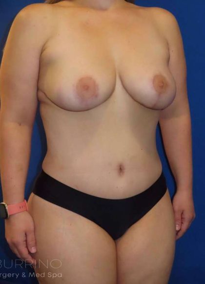 Liposuction Before & After Patient #790