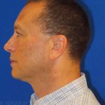 Liposuction Before & After Patient #802