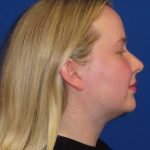 Liposuction Before & After Patient #813