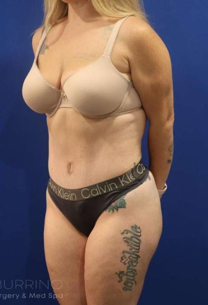 Liposuction Before & After Patient #852