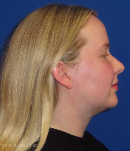 Smartlipo® Before & After Patient #463