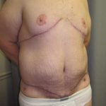 Body Contouring Before & After Patient #1004