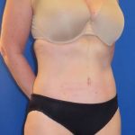 Body Contouring Before & After Patient #1065