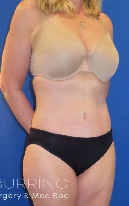 Body Contouring Before & After Patient #1065