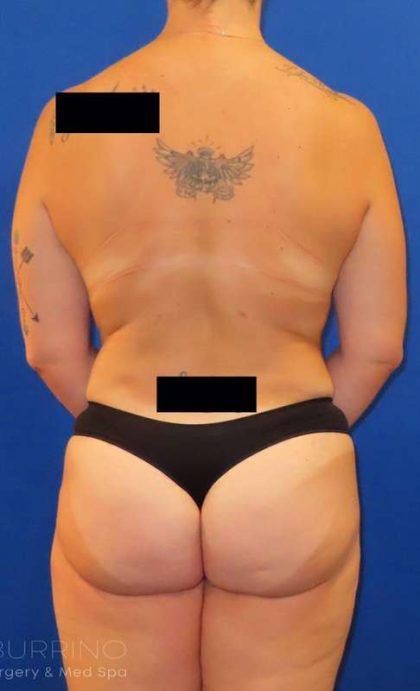 Body Contouring Before & After Patient #1078