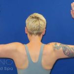 Arm Lift Before & After Patient #1096