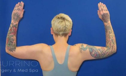 Arm Lift Before & After Patient #1096