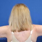 Arm Lift Before & After Patient #1101