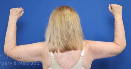 Arm Lift Before & After Patient #1101