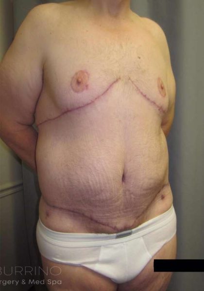 After Weight Loss Surgery Before & After Patient #1112