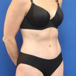 Tummy Tuck Before & After Patient #1153