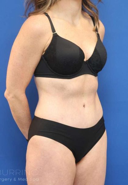 Tummy Tuck Before & After Patient #1153