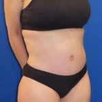 Tummy Tuck Before & After Patient #1190