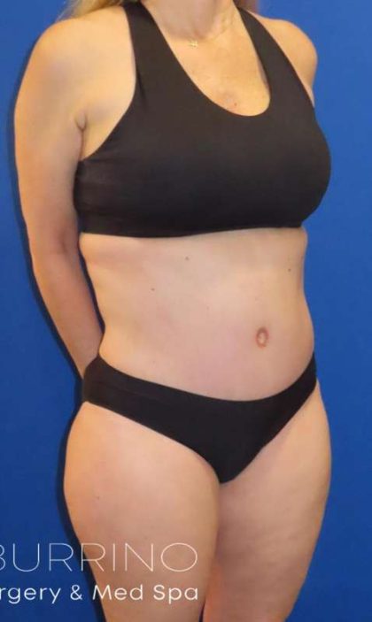 Tummy Tuck Before & After Patient #1190