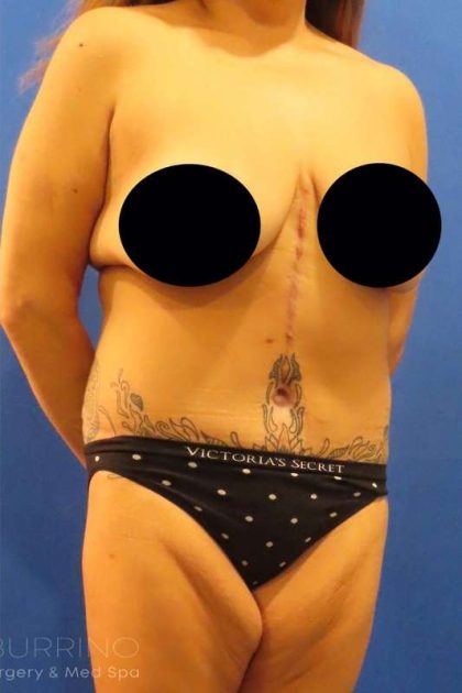Tummy Tuck Before & After Patient #1214