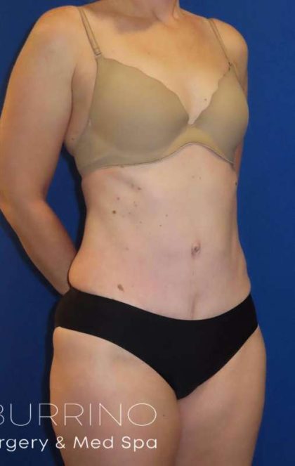 Tummy Tuck Before & After Patient #1236