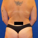 Tummy Tuck Before & After Patient #1330