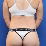 Tummy Tuck Before & After Patient #1343