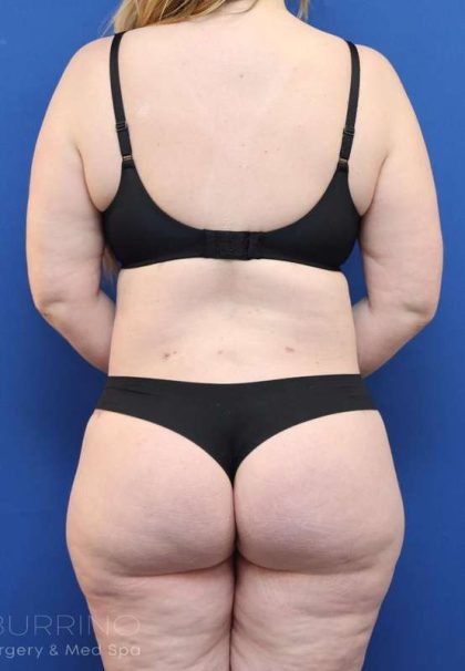 Tummy Tuck Before & After Patient #1356