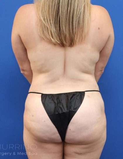 Tummy Tuck Before & After Patient #1382