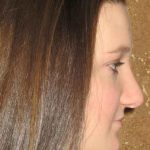 Rhinoplasty Before & After Patient #1406