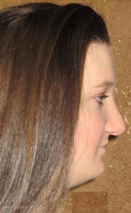 Rhinoplasty Before & After Patient #1406