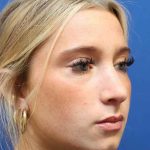 Rhinoplasty Before & After Patient #1415