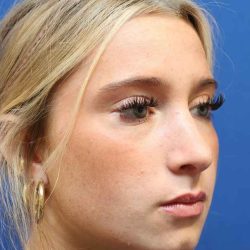 Rhinoplasty Before & After Patient #1415