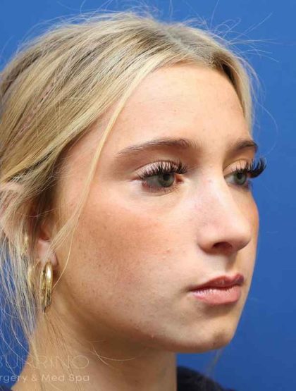 Rhinoplasty Before & After Patient #1415