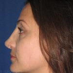 Rhinoplasty Before & After Patient #1424