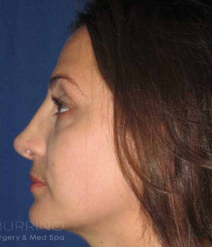 Rhinoplasty Before & After Patient #1424