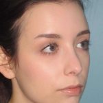 Rhinoplasty Before & After Patient #1439