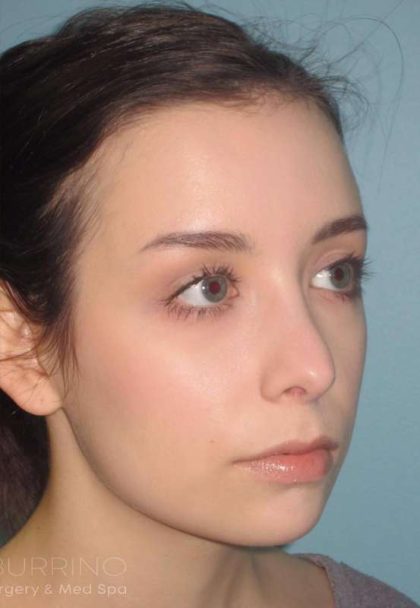Rhinoplasty Before & After Patient #1439