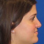 Rhinoplasty Before & After Patient #1454