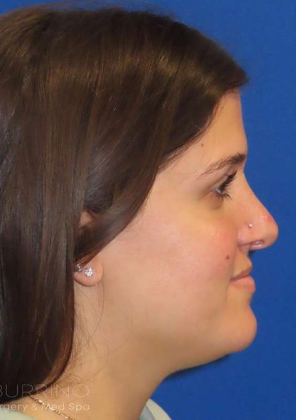Rhinoplasty Before & After Patient #1454