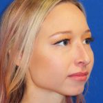 Rhinoplasty Before & After Patient #1476