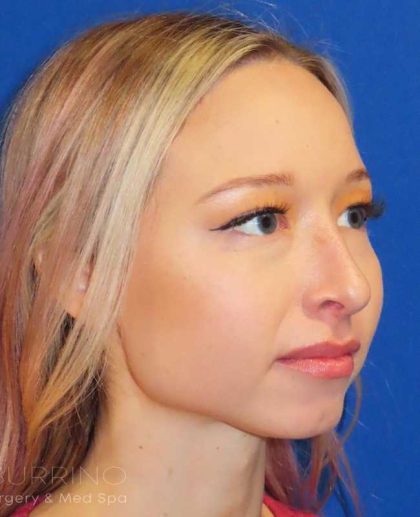 Rhinoplasty Before & After Patient #1476