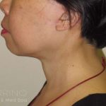 Neck Lift Before & After Patient #1498