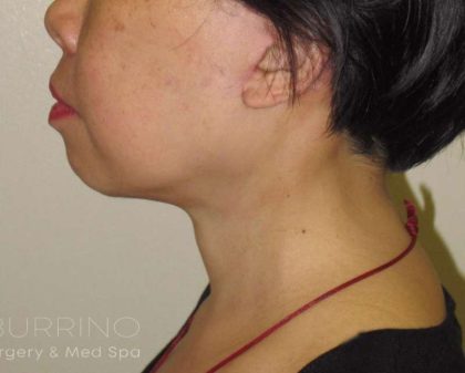 Neck Lift Before & After Patient #1498