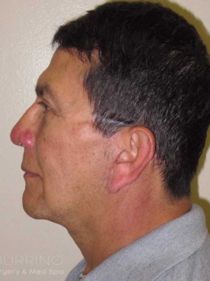 Neck Lift Before & After Patient #1520