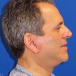 Neck Lift Before & After Patient #1560