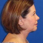 Neck Lift Before & After Patient #1578